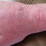 eczema - healthline.com